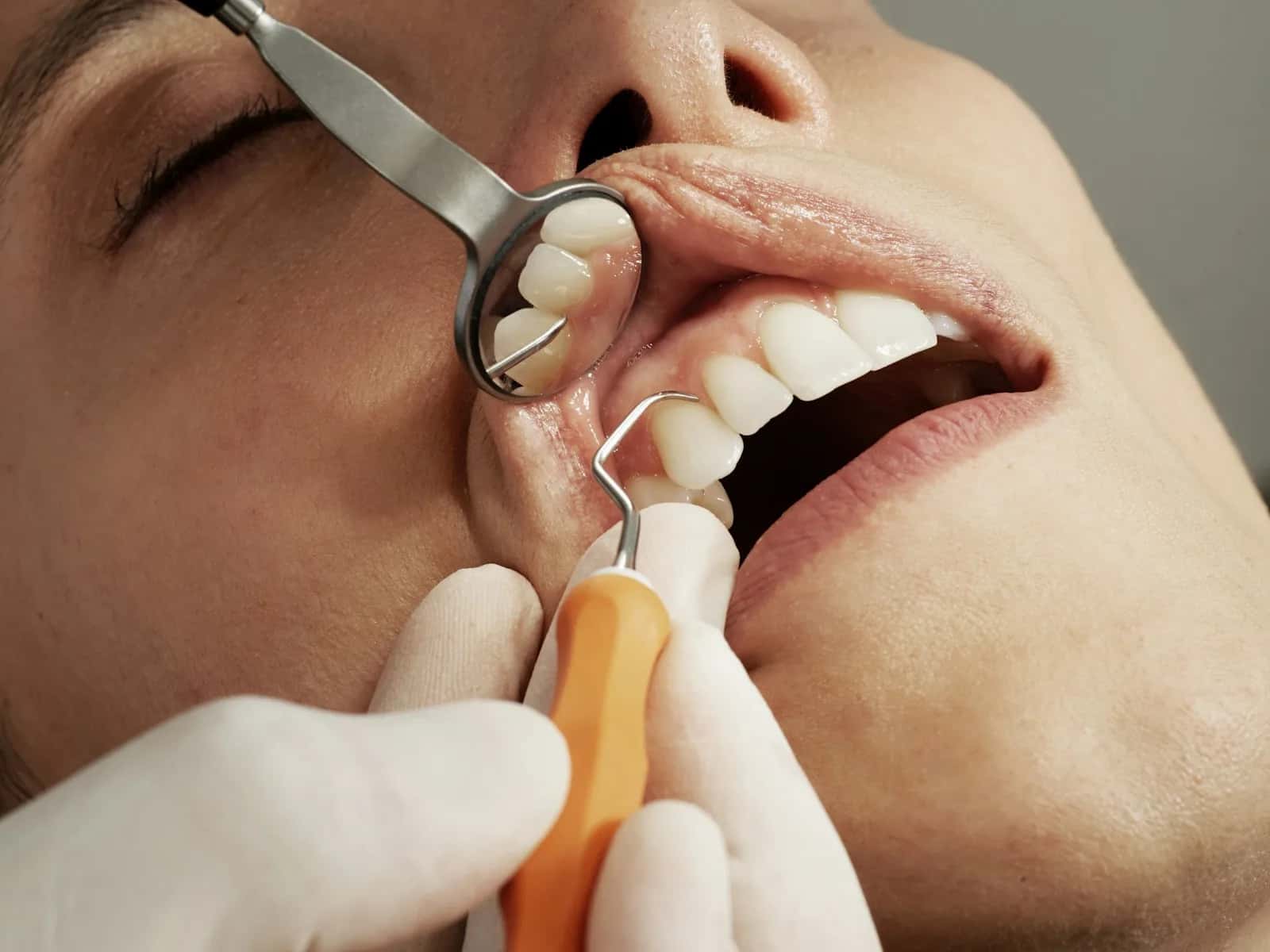 Limpieza dental